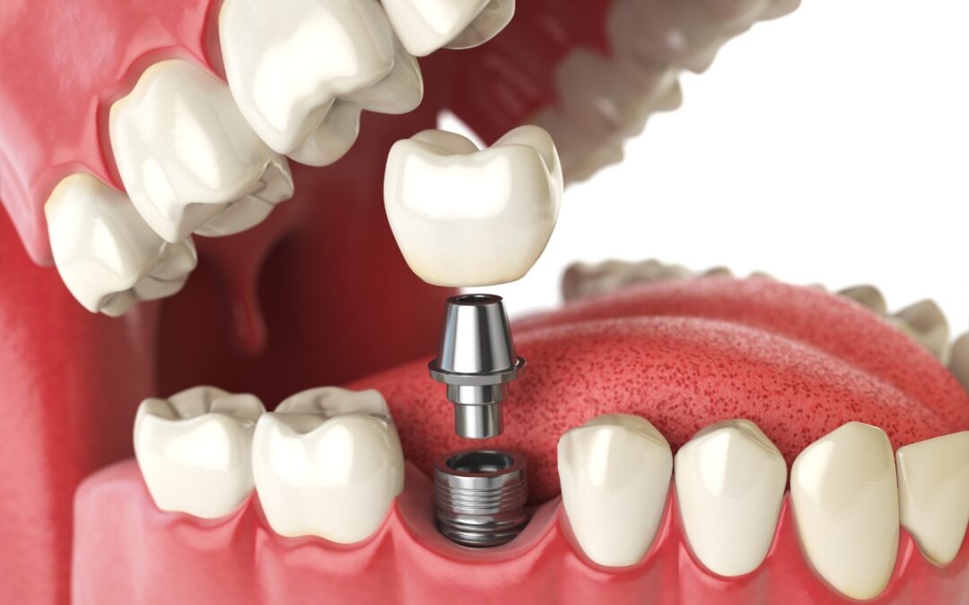 Dental Implant