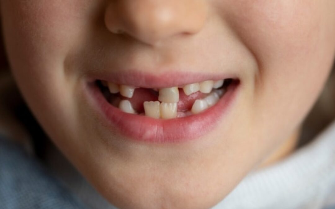Missing Teeth Affect Your Bite and Alignment