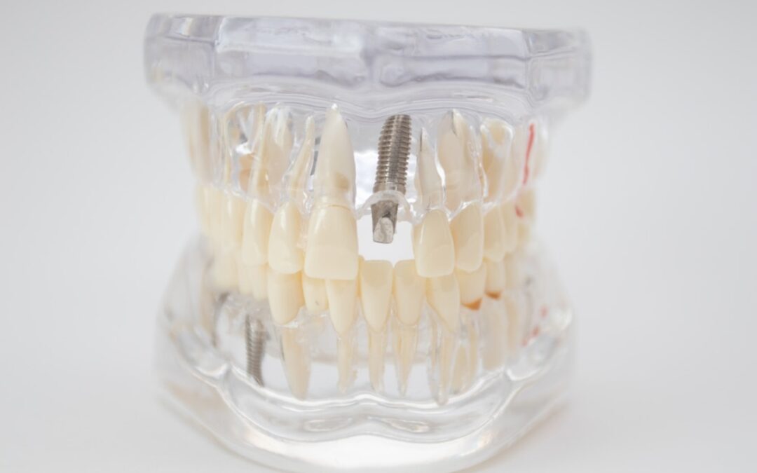 Dental Implants Webster