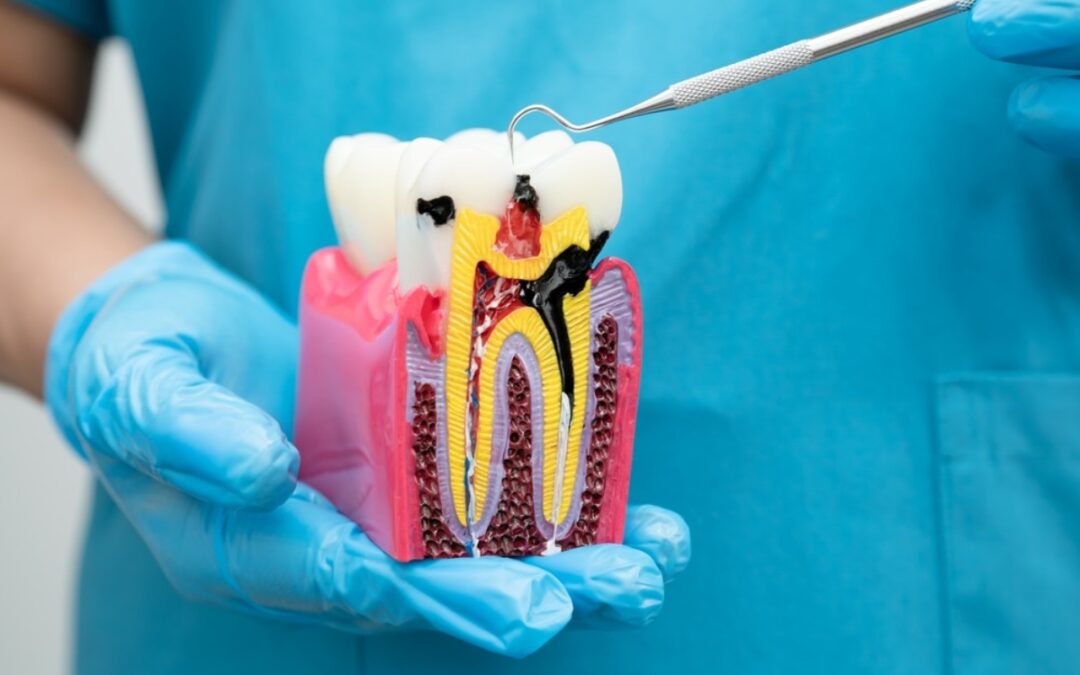 Root Canal Treatment