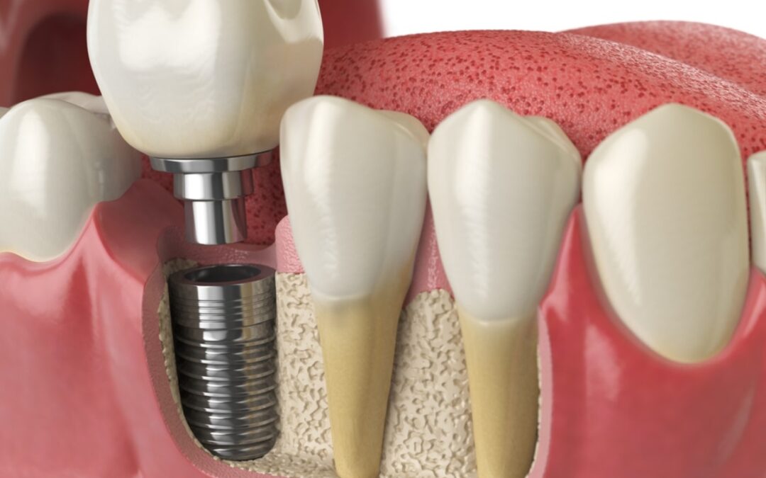 Dental Implant Webster