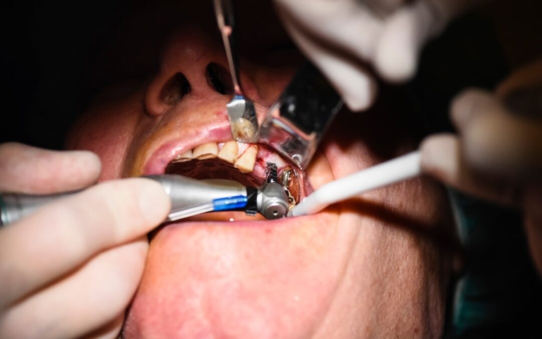 Oral Surgery-Webster