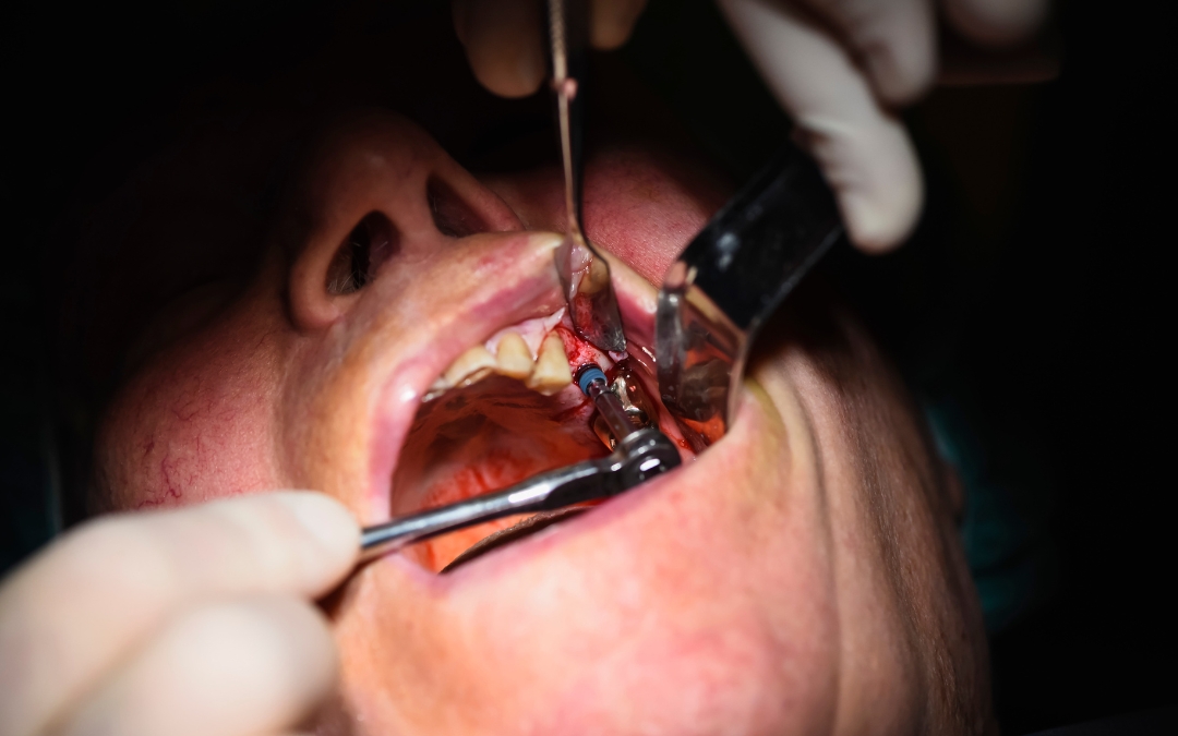 How Long Do Dental Stitches Take To Dissolve