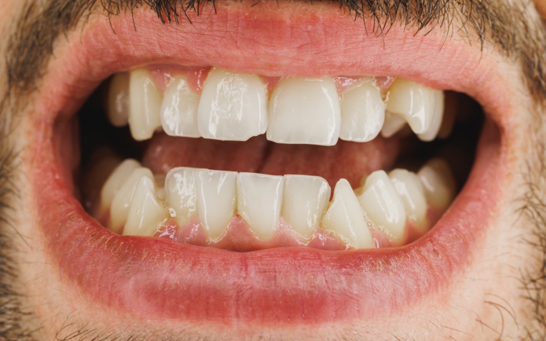 How a Cosmetic Dentist Can Fix Chipped or Crooked Teeth
