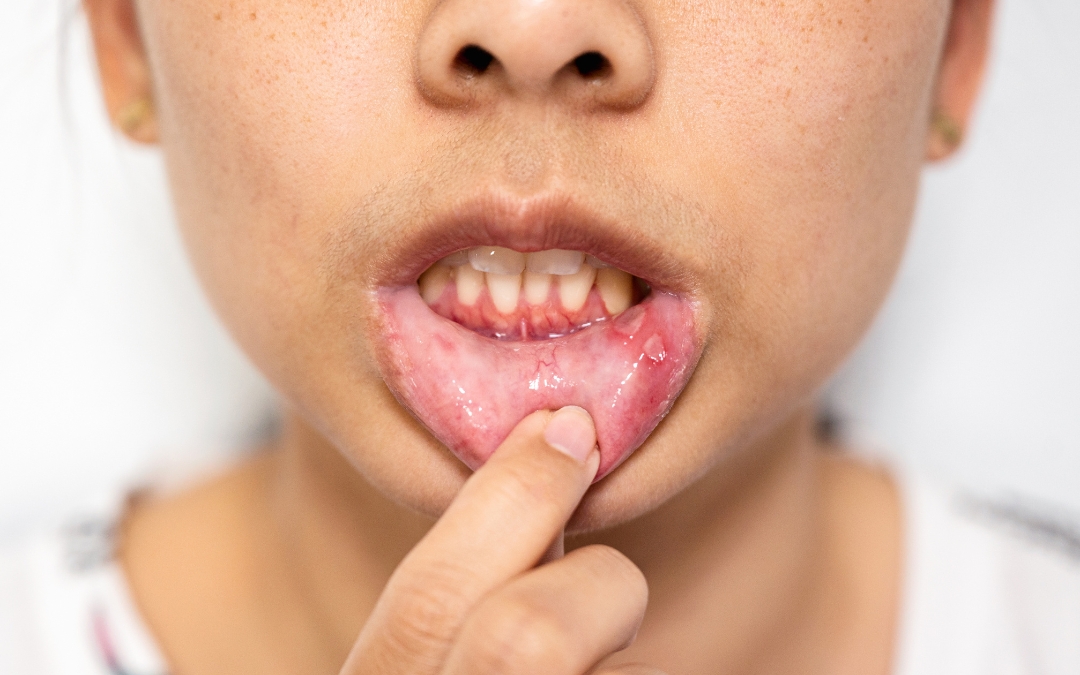 Can a Dentist Help with Chronic Mouth Ulcers
