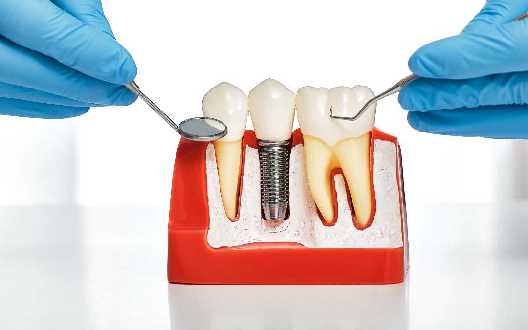 Is It Painful to Get Dental Implants? What Patients in Webster Should Know