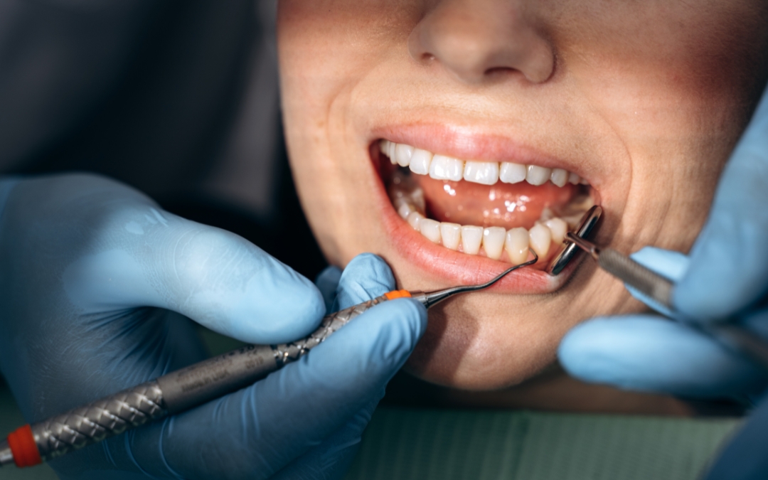 What Happens If You Leave a Broken Tooth Root in Your Mouth