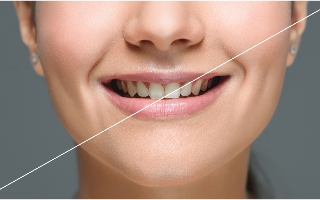 Homemade Teeth Whitening Solutions That Actually Work for Webster People
