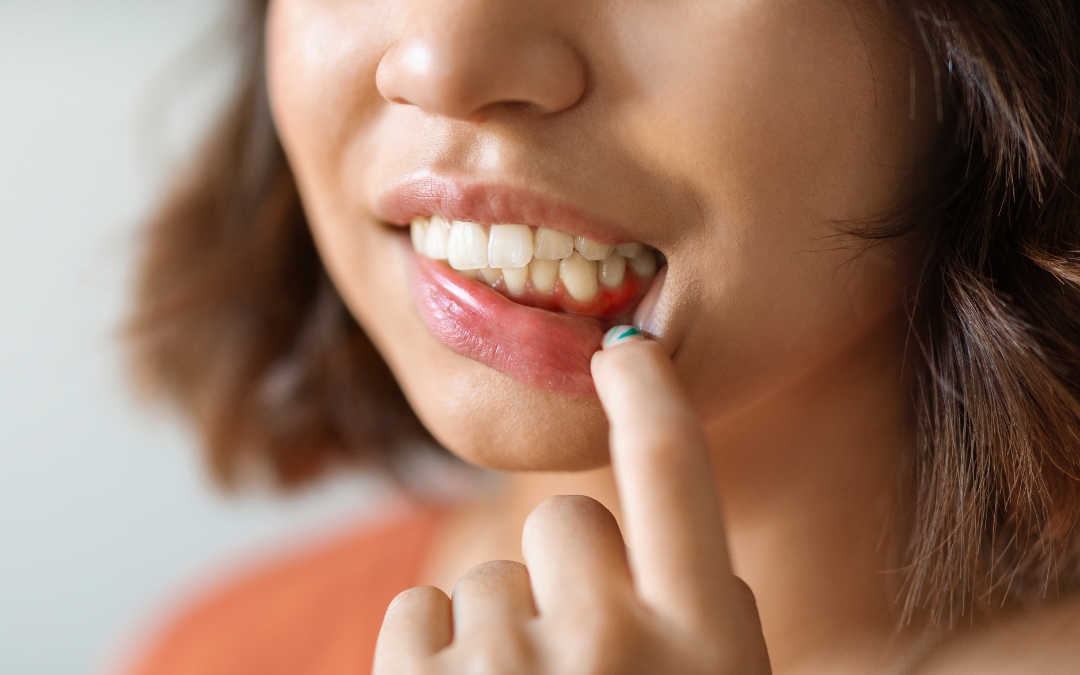 What Is the Best Antibiotic for Gum Infection