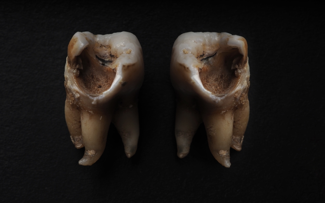 What Should You Do If a Decayed Tooth Falls Out