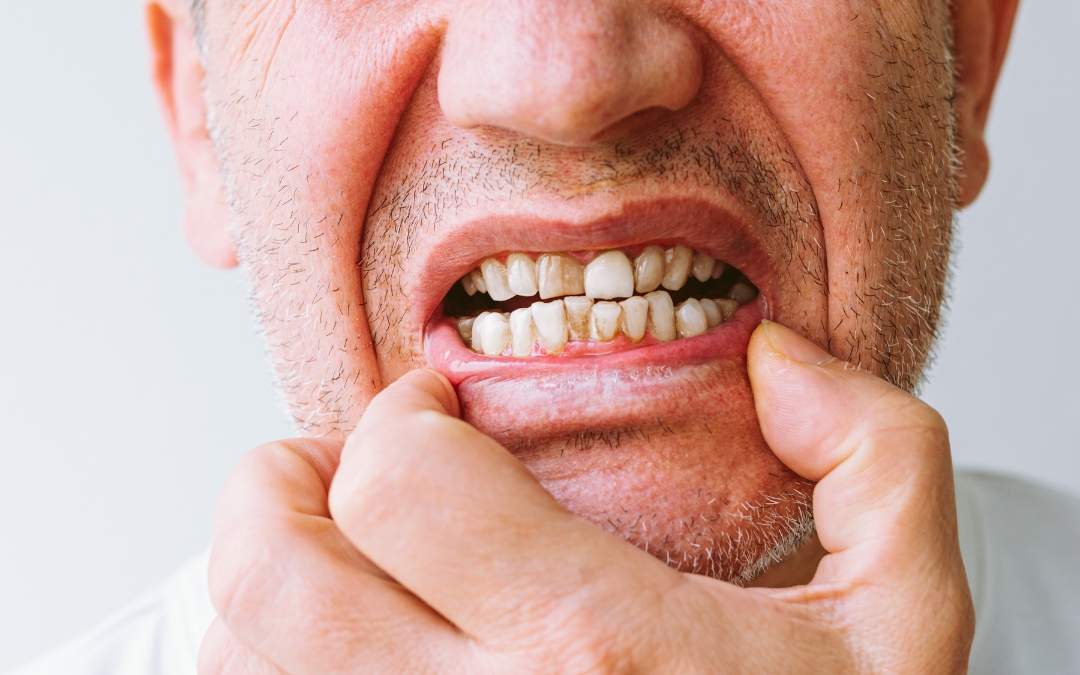 Understanding Black Spots on Teeth Causes, Removal and Prevention