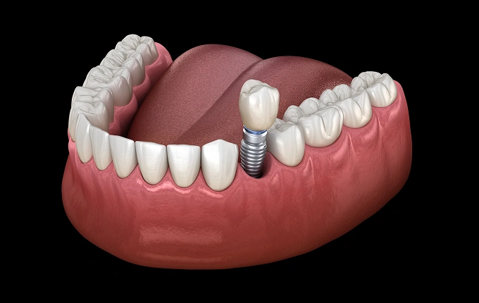 img-dental-implants Dental Implant