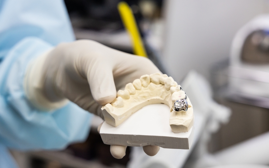 Is It Time for a Replacement? Key Signs You Need a New Dental Crown